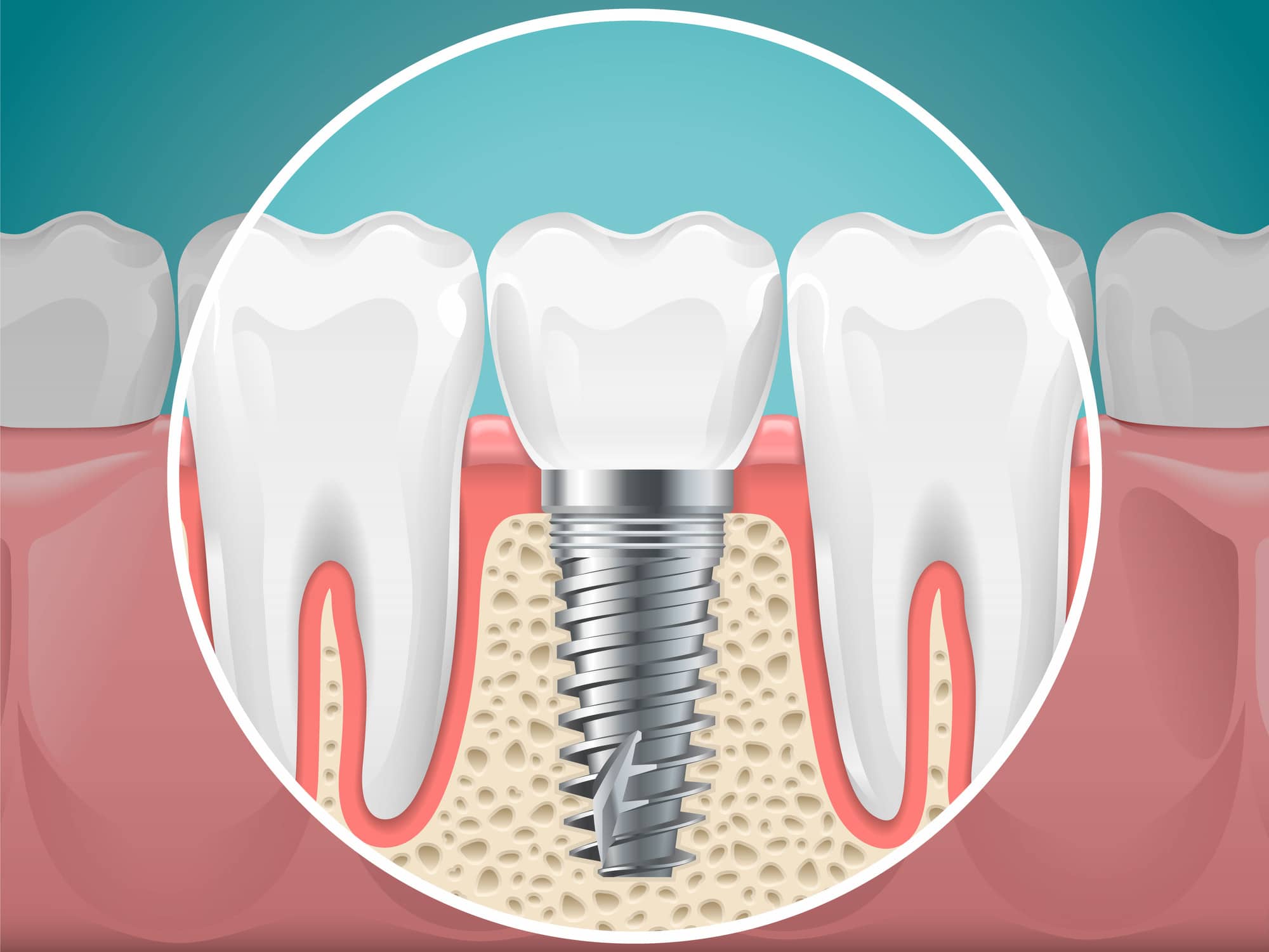 dental implant illustration